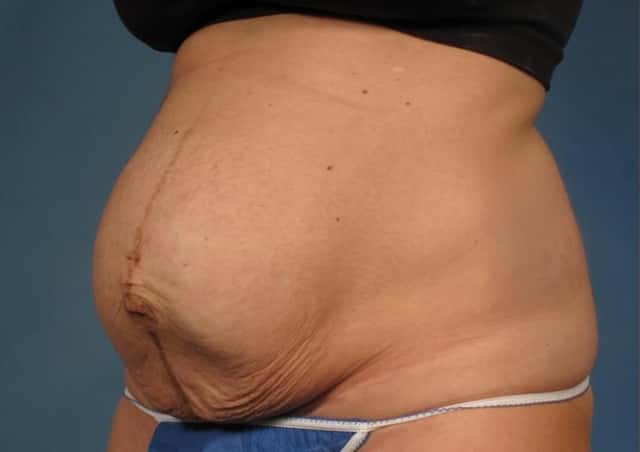 Liposuction Before & After Case 305 before