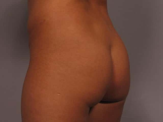 Liposuction Before & After Case 327 before