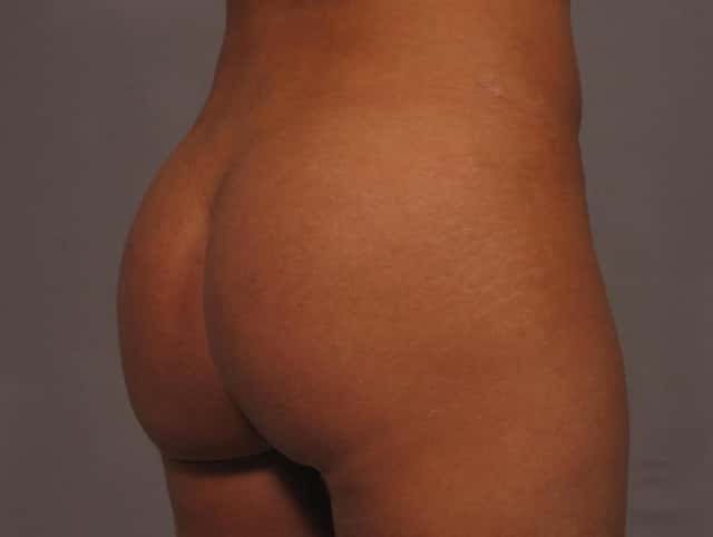 Liposuction Before & After Case 327 after