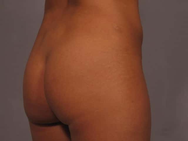 Liposuction Before & After Case 327 before