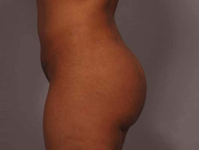 Liposuction Before & After Case 327 after