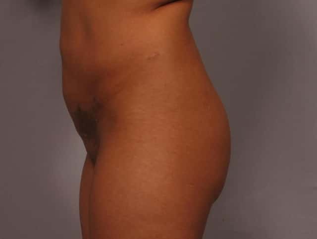 Liposuction Before & After Case 327 before