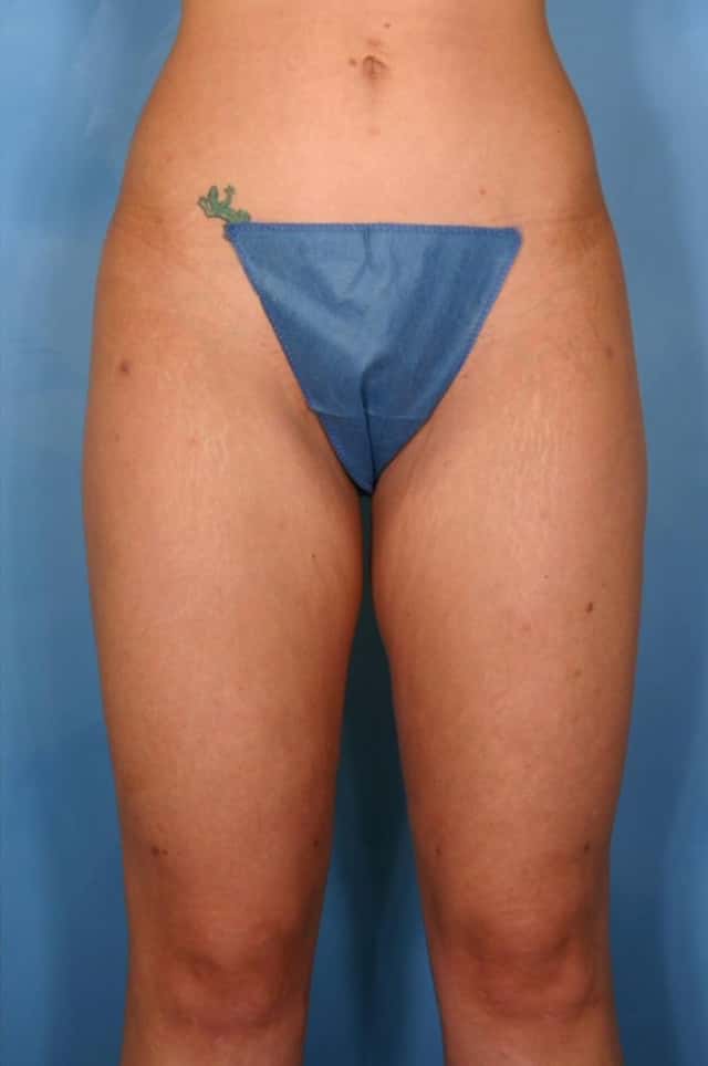 Liposuction Before & After Case 42 after