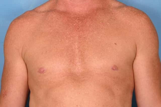 Male Breast Reduction Before & After Case 77 after