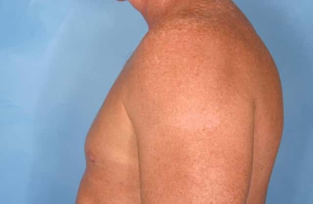 Male Breast Reduction Before & After Case 77 after