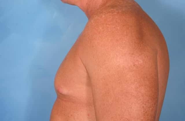 Male Breast Reduction Before & After Case 77 before