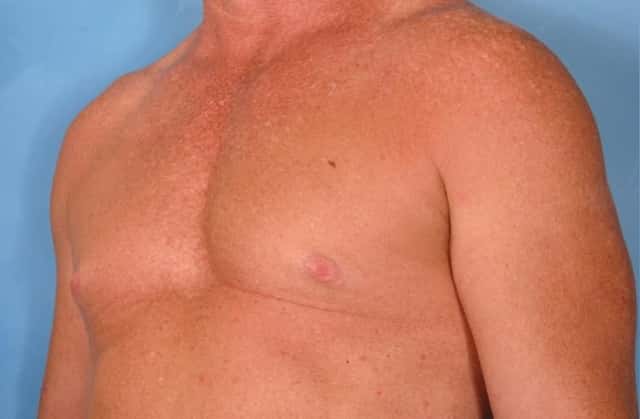 Male Breast Reduction Before & After Case 77 before