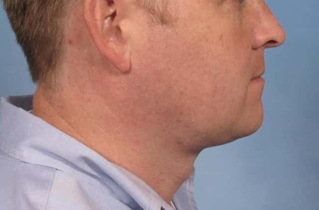 Male Face/Neck Lift Before & After Case 108 after