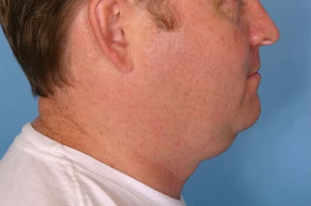 Male Face/Neck Lift Before & After Case 108 before