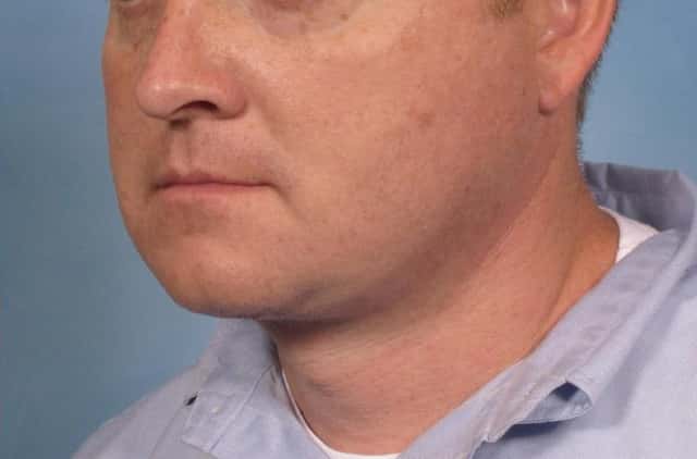 Male Face/Neck Lift Before & After Case 108 after