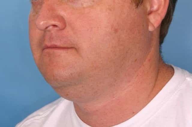 Male Face/Neck Lift Before & After Case 108 before