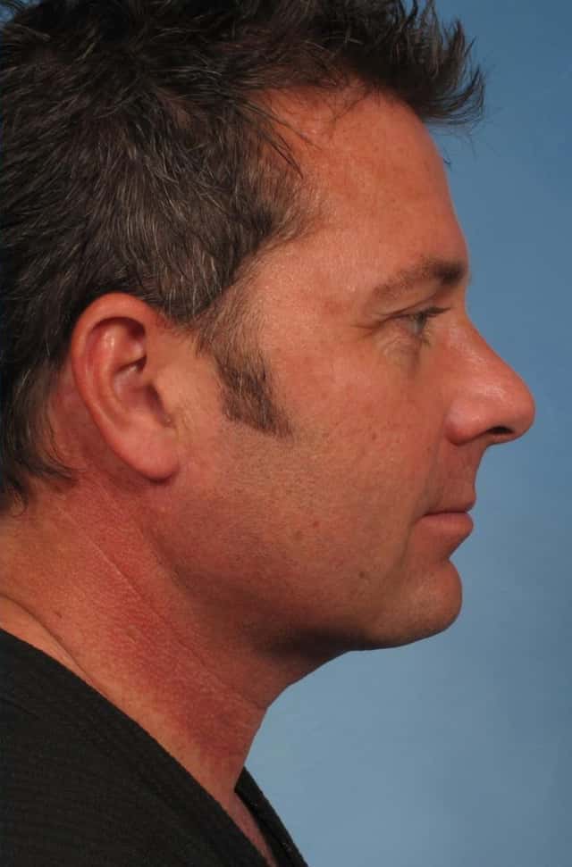 Male Face/Neck Lift Before & After Case 163 after