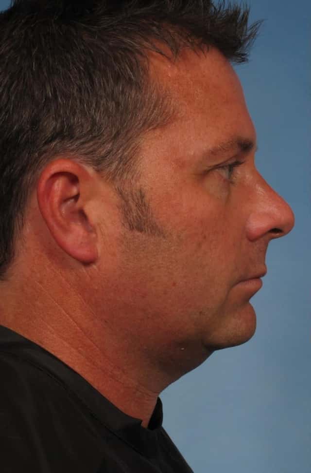 Male Face/Neck Lift Before & After Case 163 before