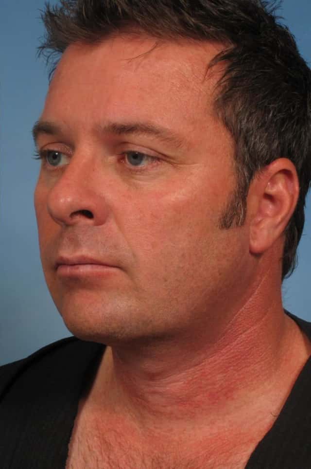 Male Face/Neck Lift Before & After Case 163 after