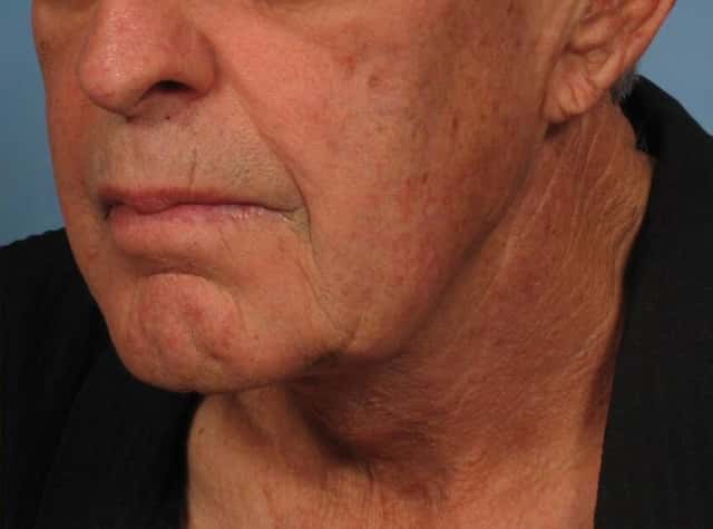 Male Face/Neck Lift Before & After Case 186 after