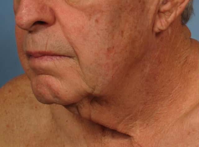 Male Face/Neck Lift Before & After Case 186 before