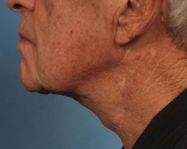 Male Face/Neck Lift Before & After Case 186 after