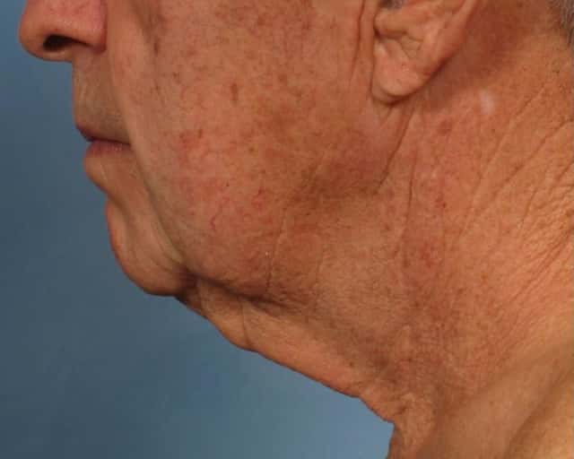 Male Face/Neck Lift Before & After Case 186 before