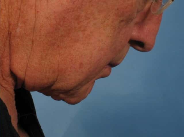 Male Face/Neck Lift Before & After Case 186 after