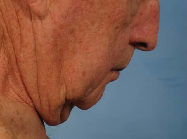 Male Face/Neck Lift Before & After Case 186 before