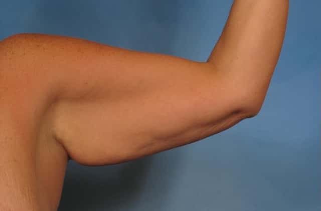 Massive Weight Loss Before & After Case 194 before