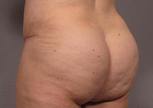 Mommy Makeover Before & After Case 311 after