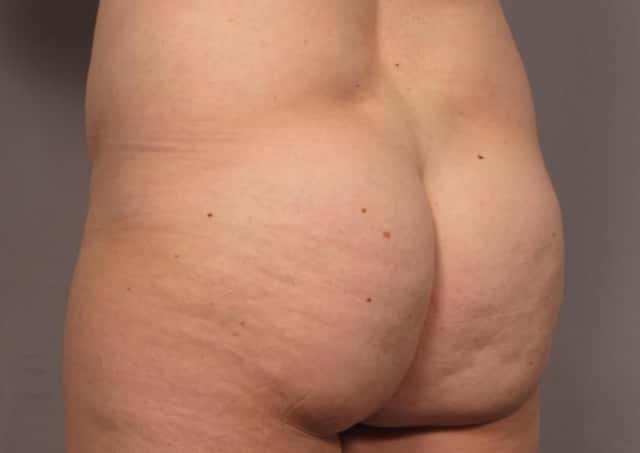 Mommy Makeover Before & After Case 311 before