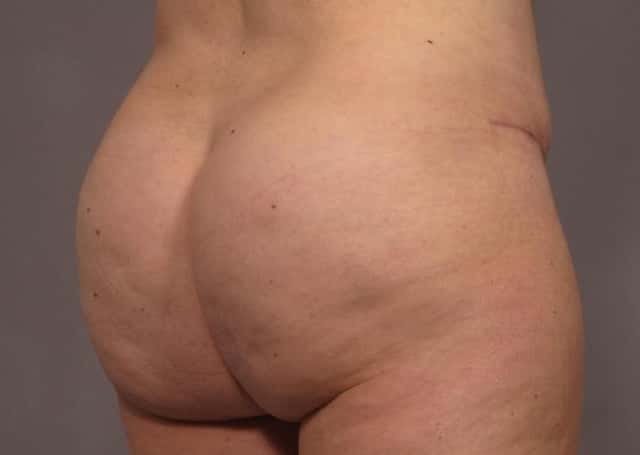 Mommy Makeover Before & After Case 311 after