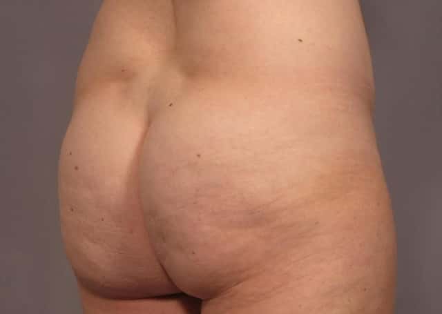 Mommy Makeover Before & After Case 311 before