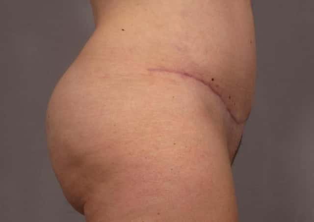 Mommy Makeover Before & After Case 311 after