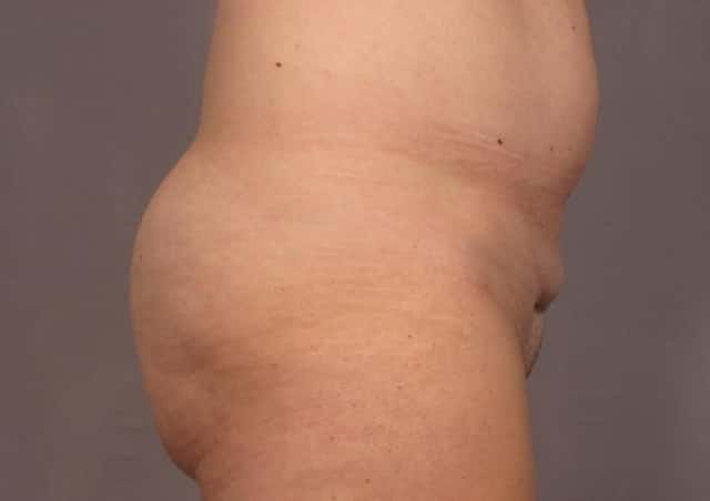 Mommy Makeover Before & After Case 311 before