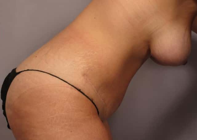 Mommy Makeover with Breast Lift, Tummy Tuck and Liposuction after