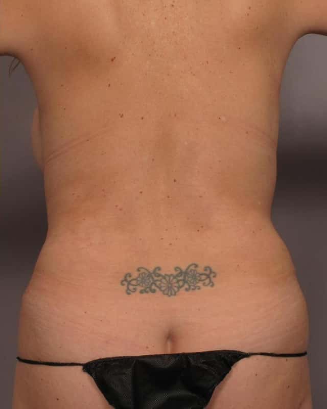 45 Year Old Female has Mommy Makeover in Naples, Florida with Dr. Kent Hasen after