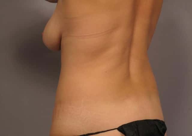 Posterior Oblique view preop of Mommy Makeover Patient