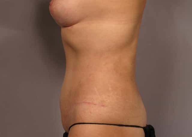 side view 3 months after mommy makeover