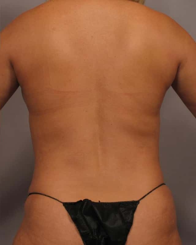 Back View of Dr. Hasen's patient who had Mommy Makeover, 1 Year Post-op
