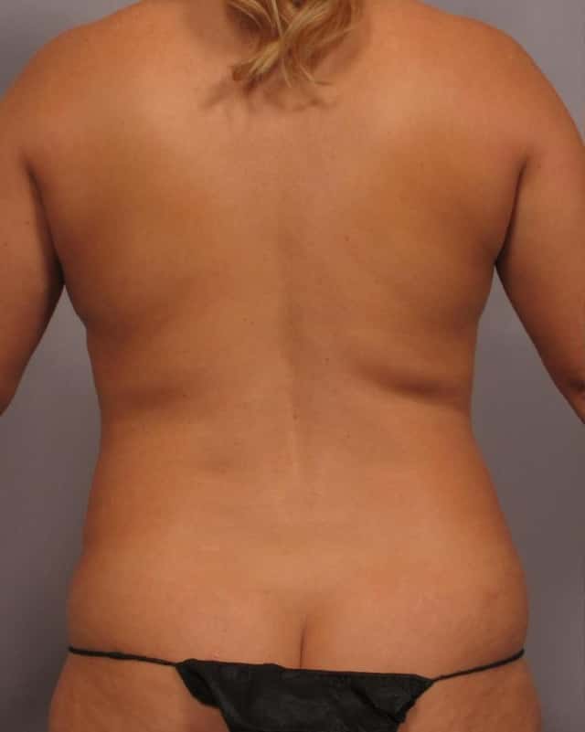 Back View of Dr. Hasen's patient who had Mommy Makeover, Before