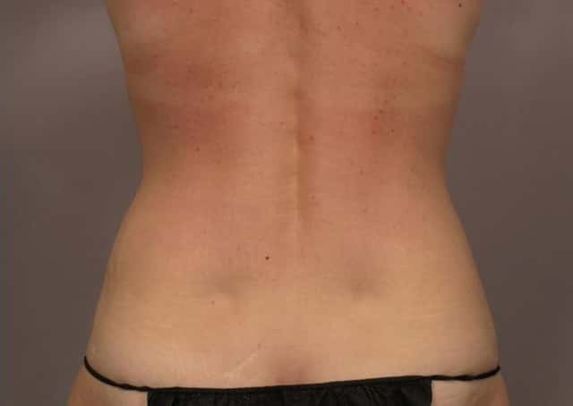 Mommy Makeover Before and 7 Years After by Dr. Kent V. Hasen