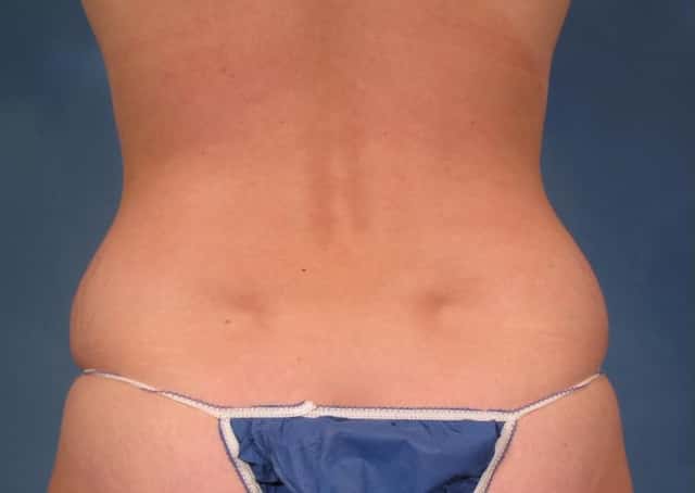 Mommy Makeover, Posterior View, Before and 7 Years After Photos by Dr. Kent V. Hasen