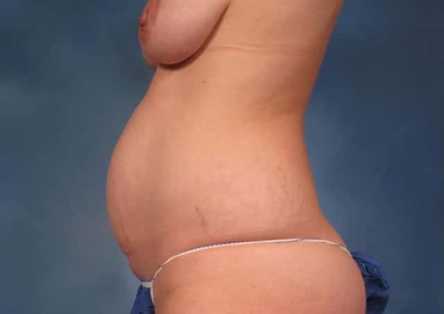 Mommy Makeover, Left Side View, Before and 7 years After Photos by Dr. Kent V. Hasen