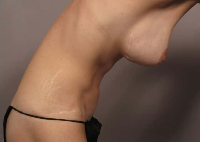 Before and 7 Years After Mommy Makeover by Dr. Kent V. Hasen