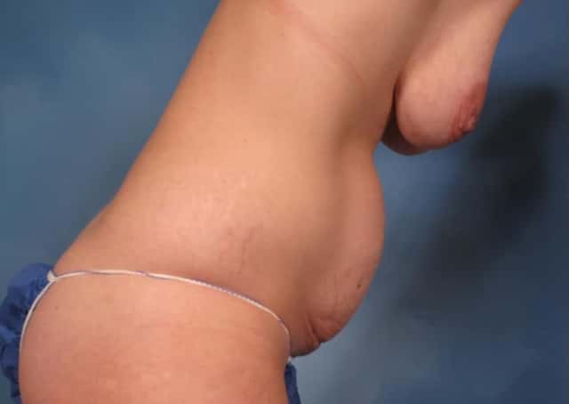 Mommy Makeover, Right Side Down View, Before and 7 Years After Photos by Dr. Kent V. Hasen
