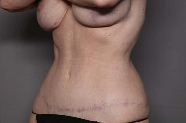 Tummy Tuck, Left Oblique 1 Year Post Op
