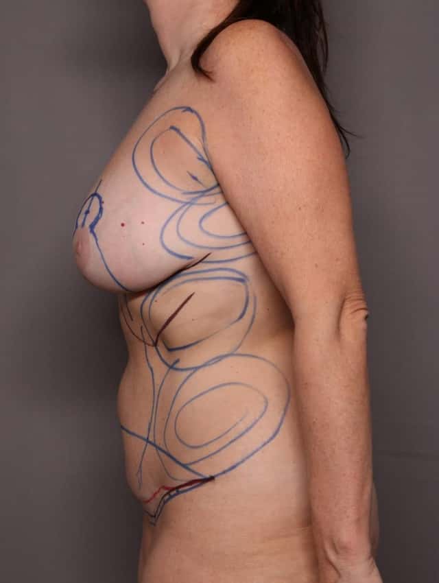 Mommy Makeover Left Side Pre