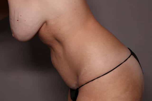 Tummy Tuck, Left Side Lean Down Pre Op