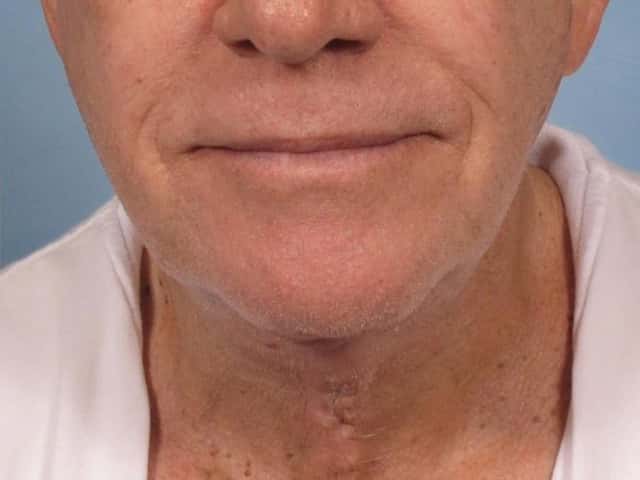 Neck Lift Before & After Case 187 after