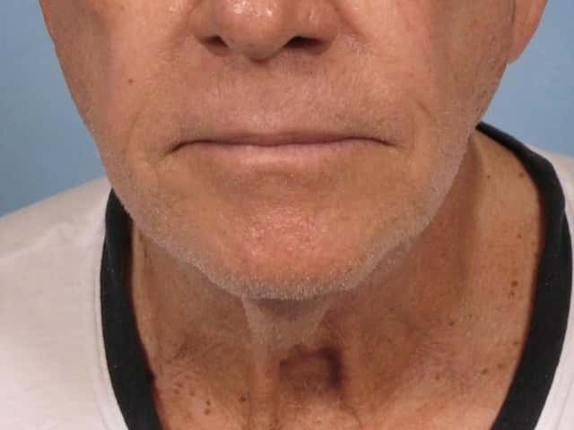 Neck Lift Before & After Case 187 before
