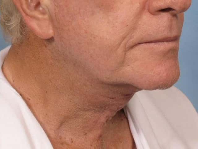 Neck Lift Before & After Case 187 after