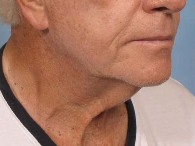 Neck Lift Before & After Case 187 before