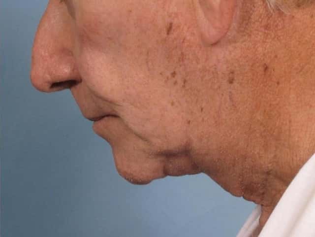 Neck Lift Before & After Case 187 after